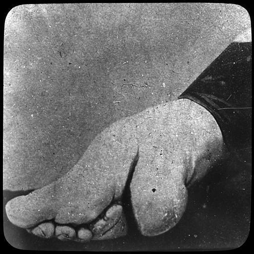 Témoignage de la présence européenne en Chine, vers 1905, Pied déformé d'une femme : 'petit pied chinois'